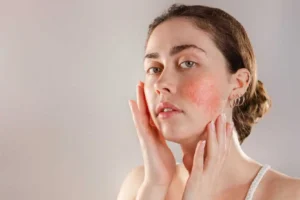 Rosacea Treatments in Valencia , CA by DermaCure of Valencia