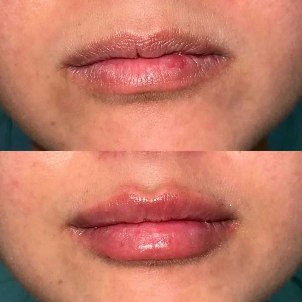 DermaCure of Valencia Expert Dermal Fillers in Valencia, CA