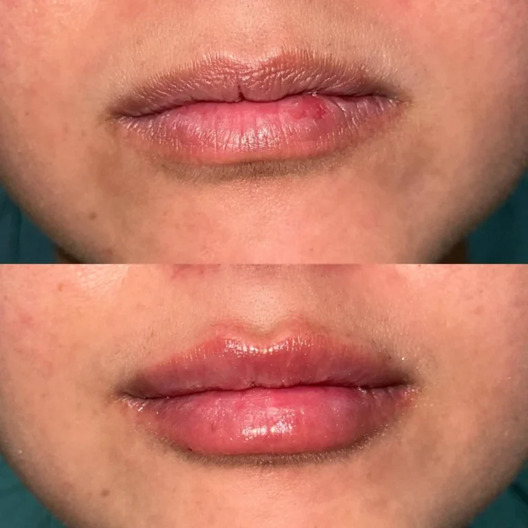 Expert Dermal Fillers in Valencia, CA 12 filler