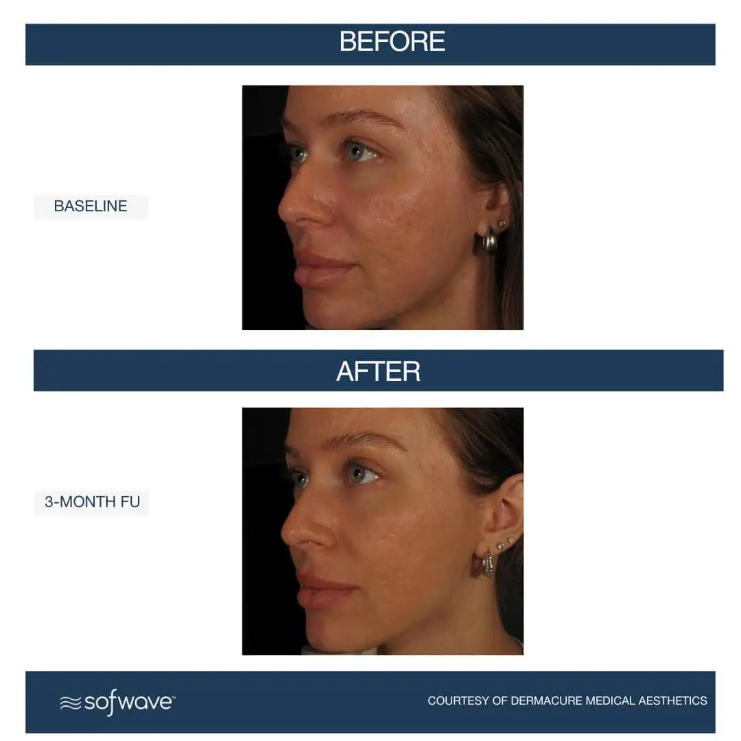 Set-105-Acne-Scars