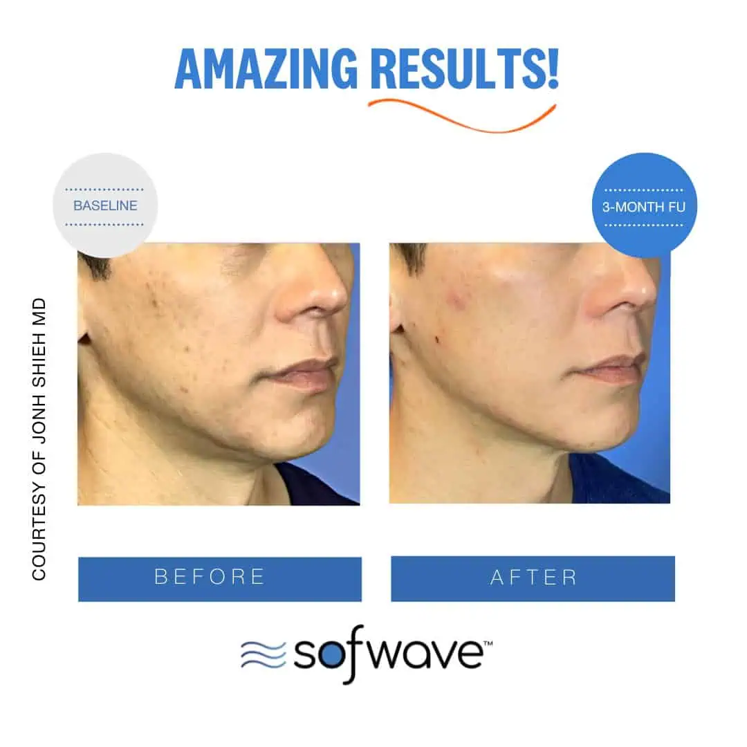 Set-47-Acne-Skin-Type-4