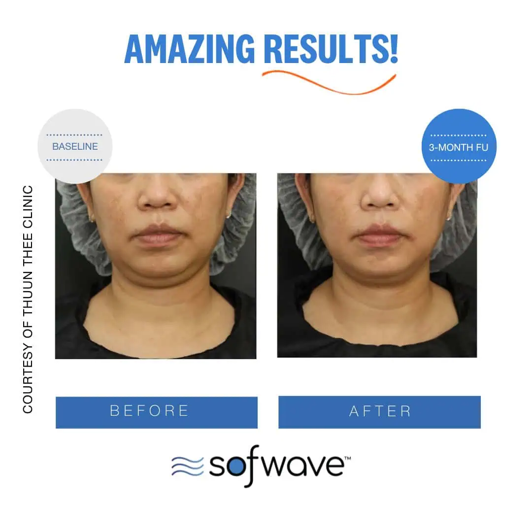 Set-52-Lower-Face-Skin-Type-4