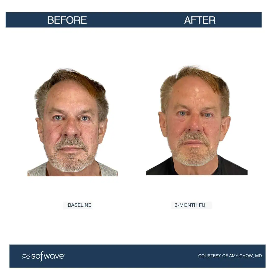 Set-62-Full-Face