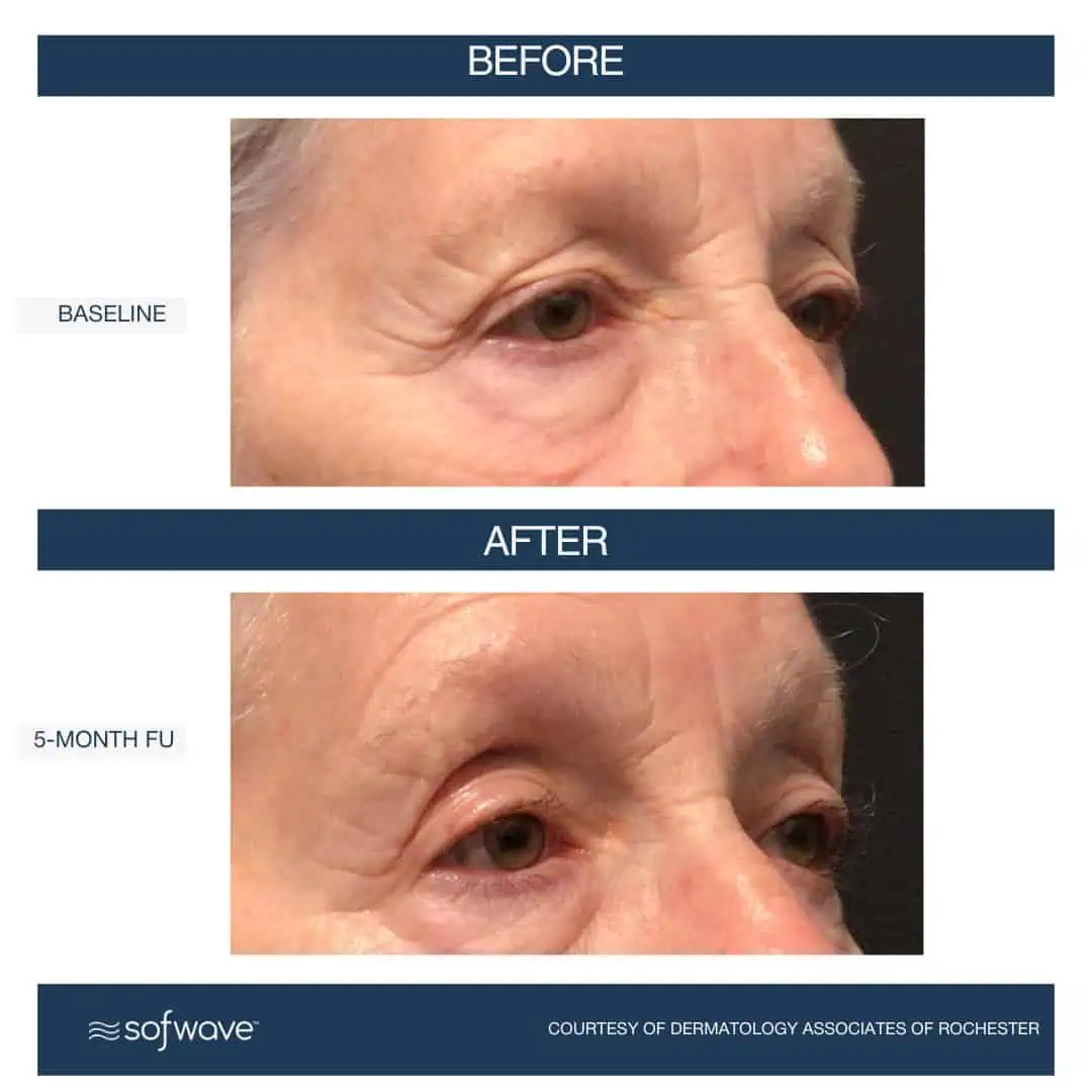 Set-67-Eyebrow