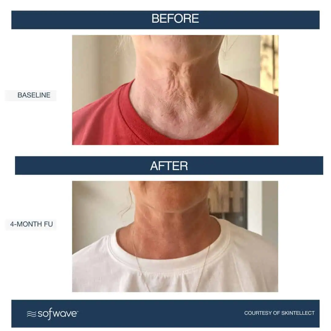 Set-79-Lower-Face-Neck