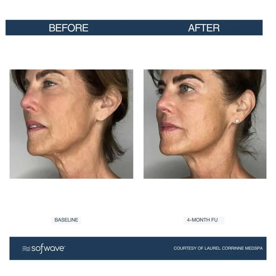 Set-88-Face-Neck