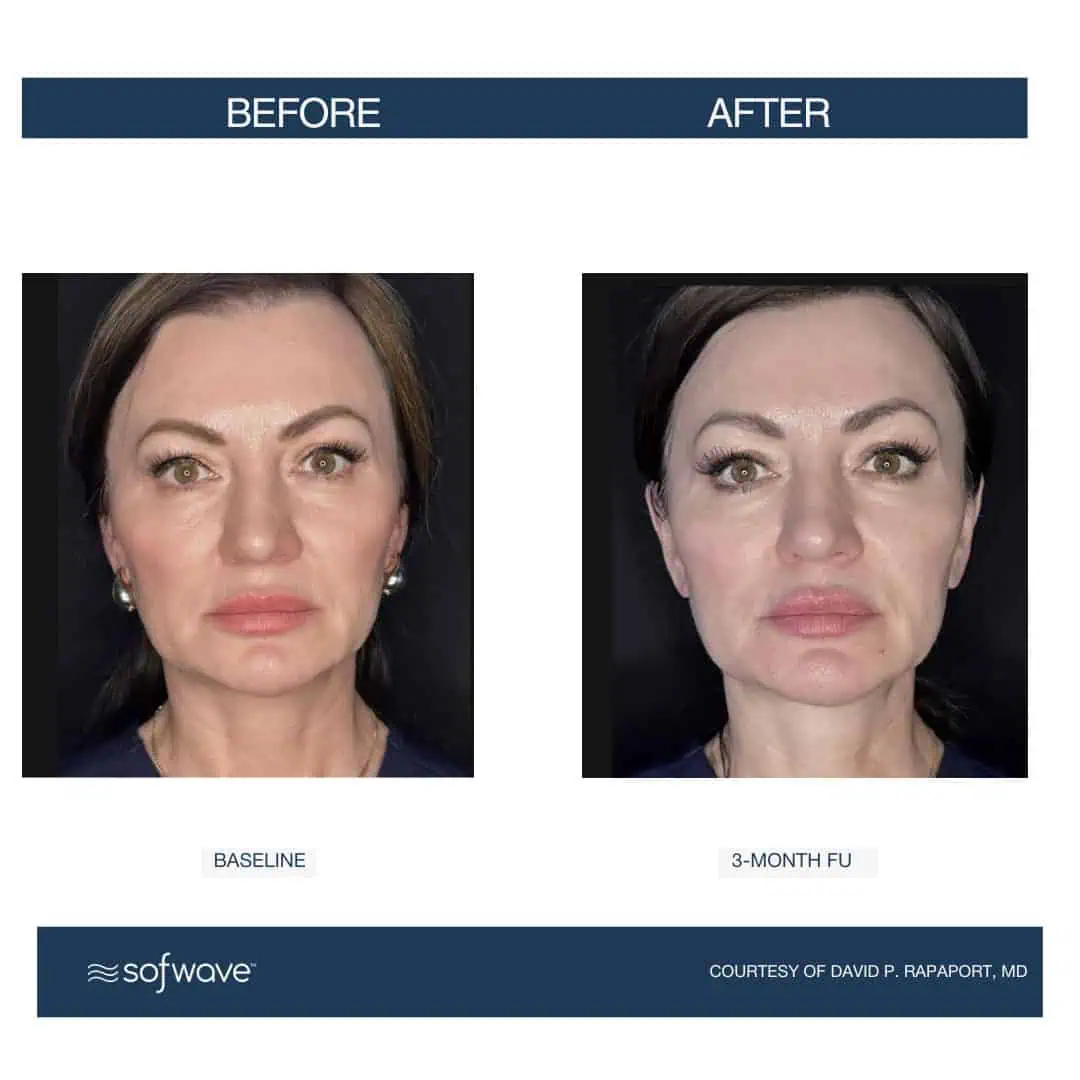 Set-90-Face-Submental