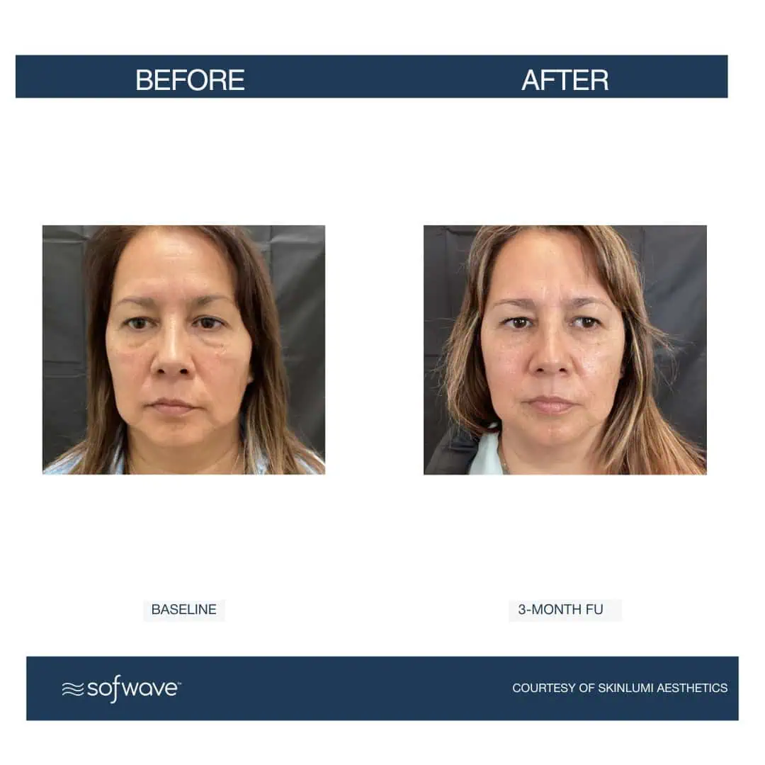 Set-91-Full-Face