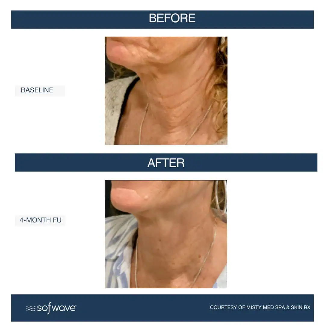 Set-95-Face-Neck