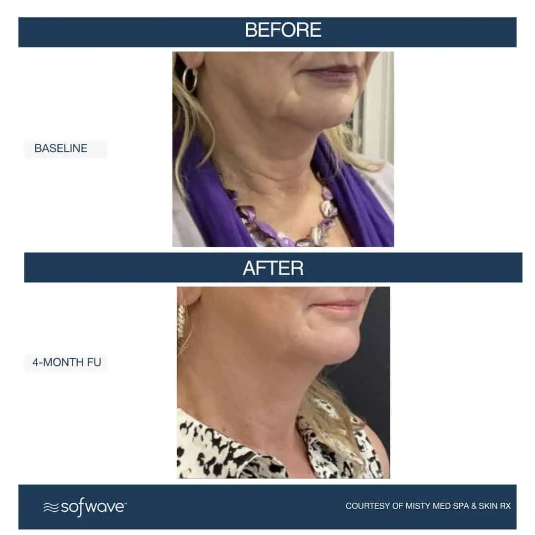 Set-96-Face-Neck