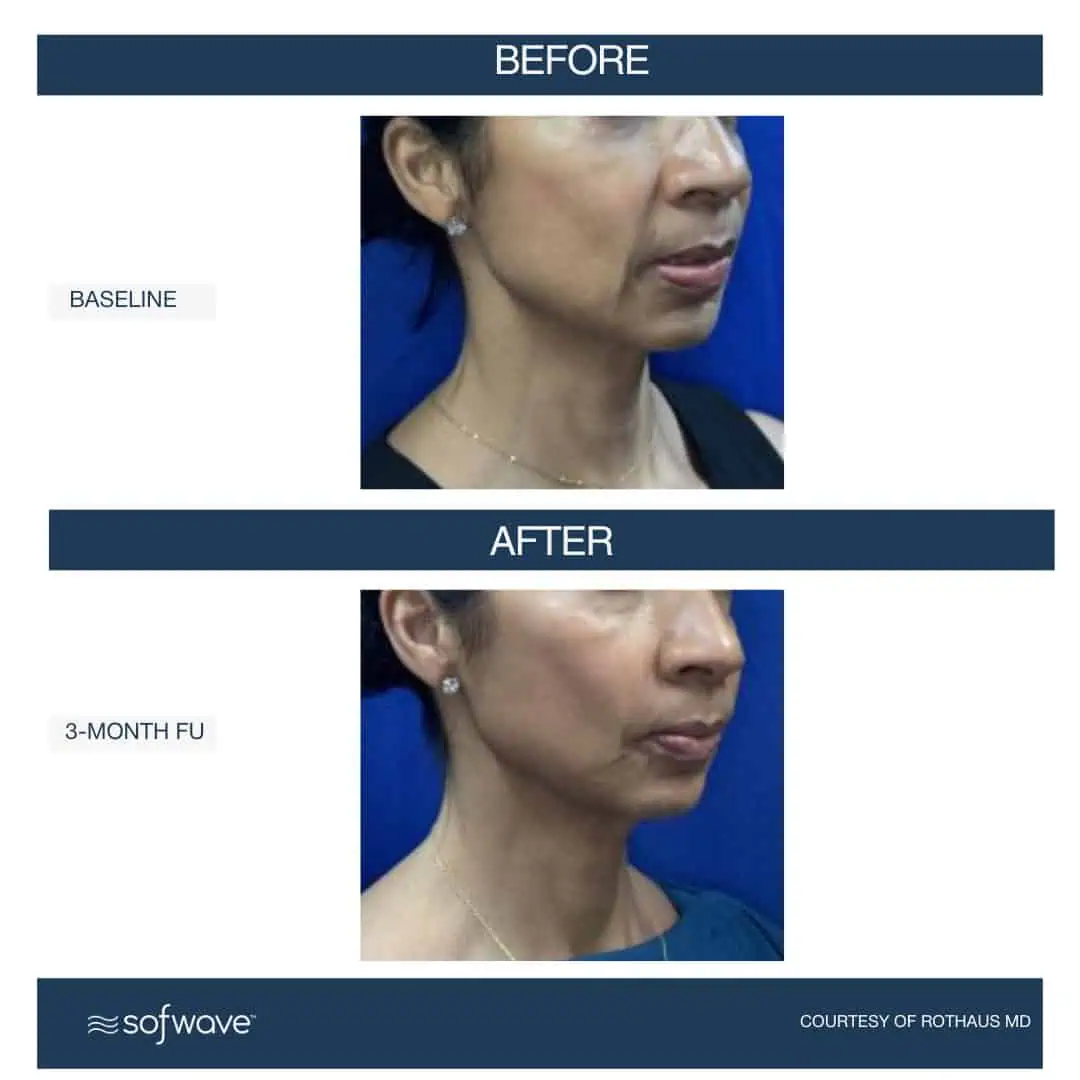 Set-98-Cheeks-Neck