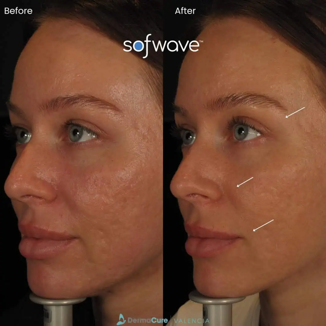 Sofwavebeforeafter (3)