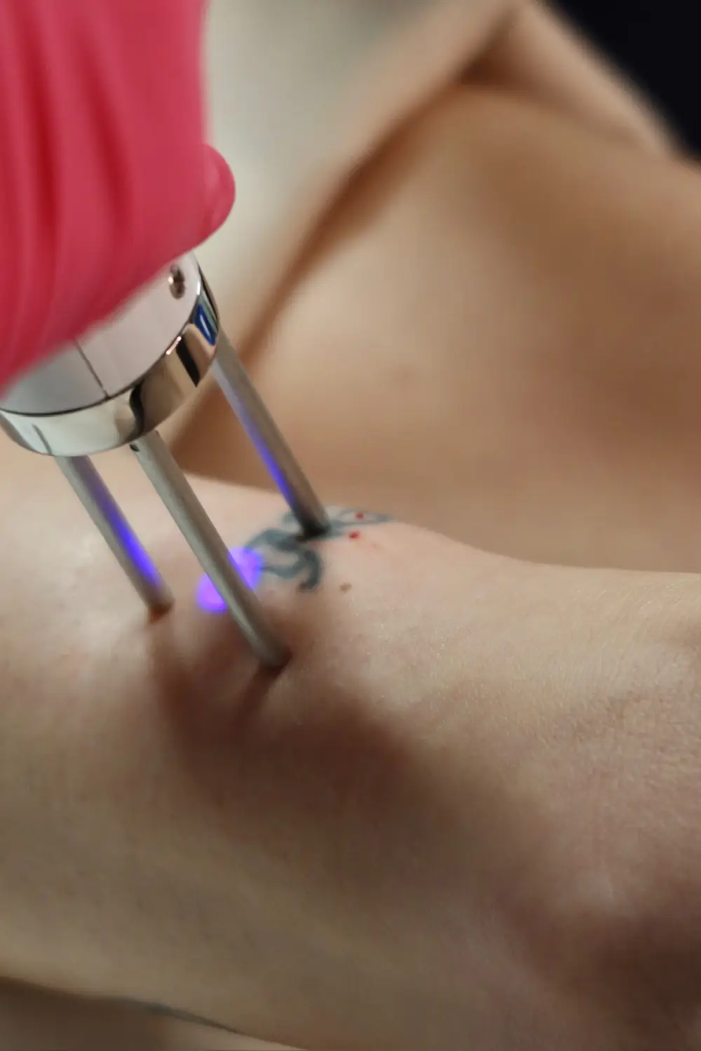 Laser Tattoo Removal in Valencia, CA 2 Laser Tattoo Removal in Valencia, CA