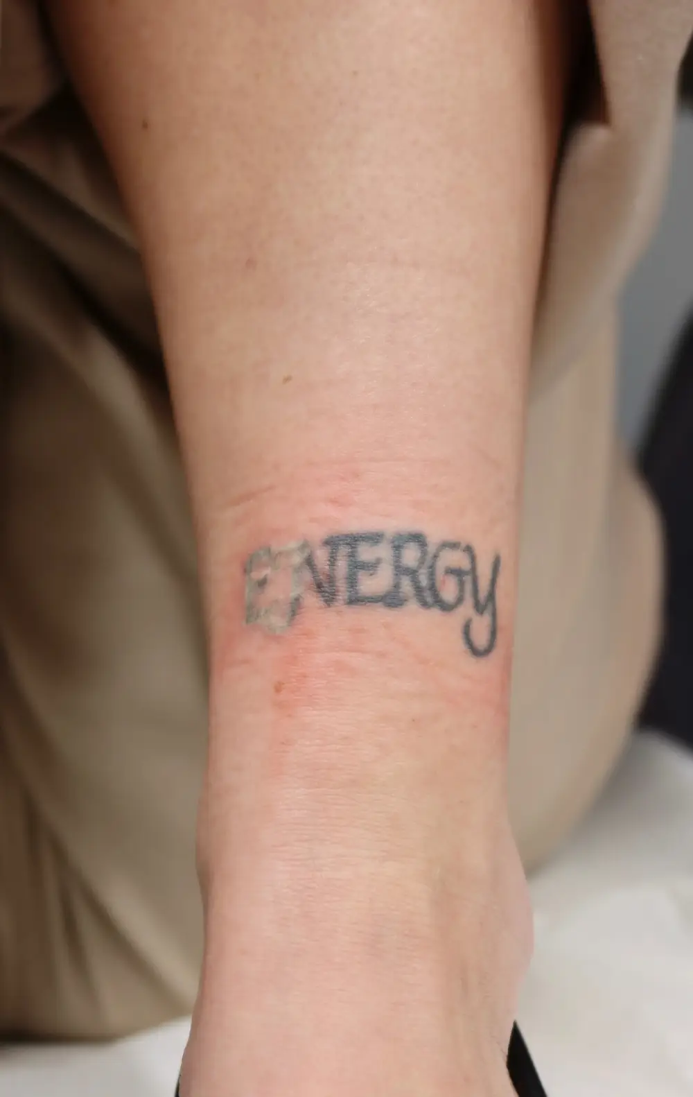 Laser Tattoo Removal in Valencia, CA 1 Laser Tattoo Removal in Valencia, CA 2