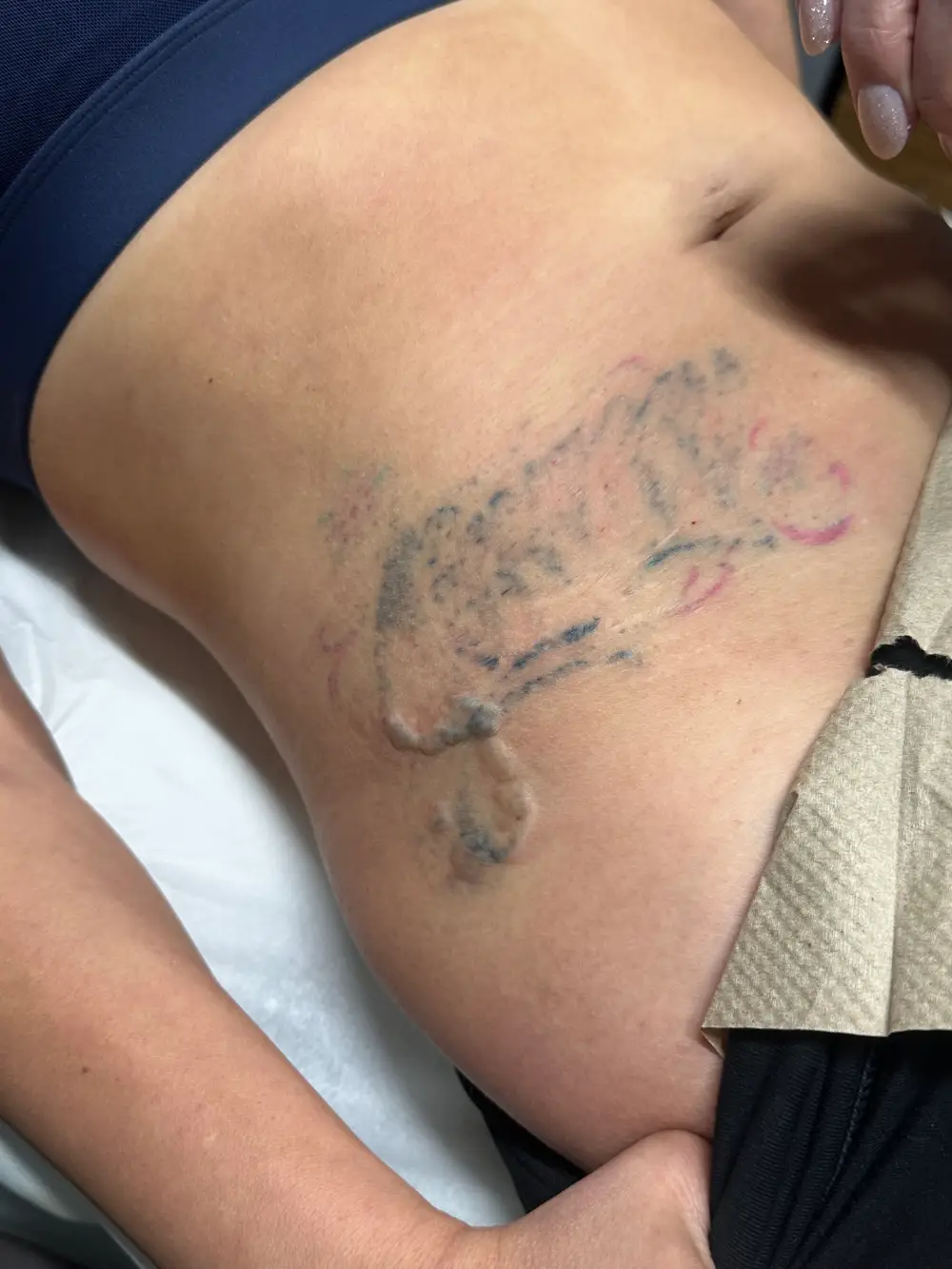 Laser Tattoo Removal in Valencia, CA 4 DermaCure of Valencia Laser Tattoo Removal in Valencia, CA