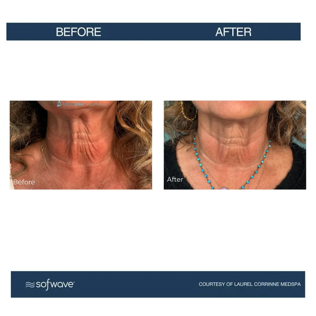 before & after Sofwave page-1