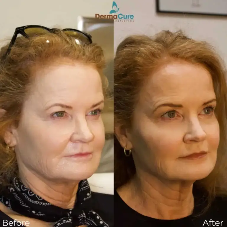 Expert Dermal Fillers in Valencia, CA 3 dermal filler