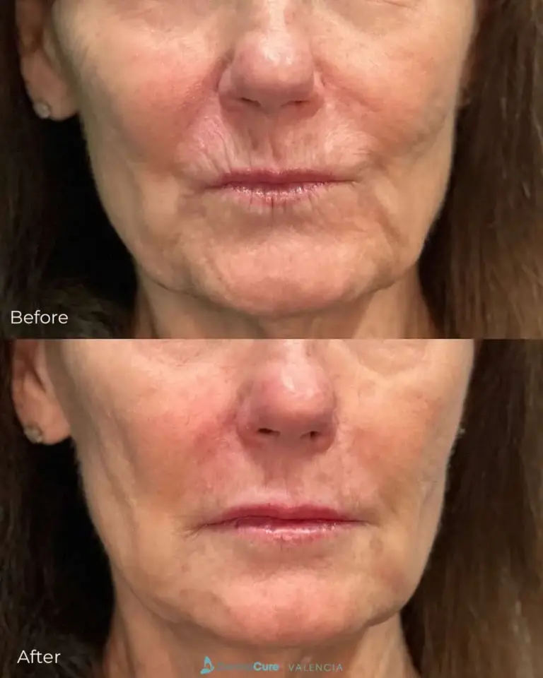 Expert Dermal Fillers in Valencia, CA 4 lip filler
