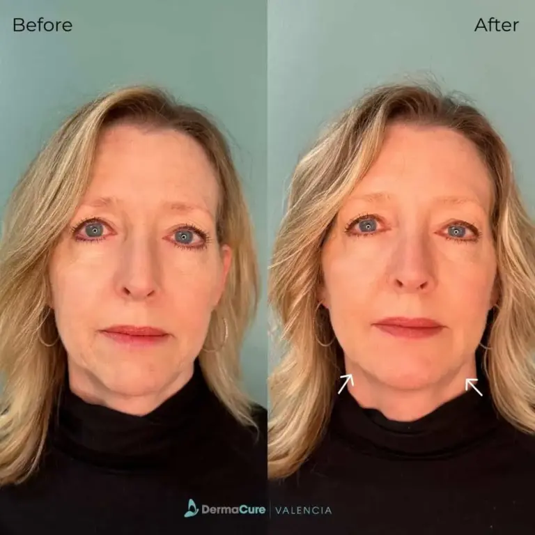 Expert Dermal Fillers in Valencia, CA 5 dermal filler
