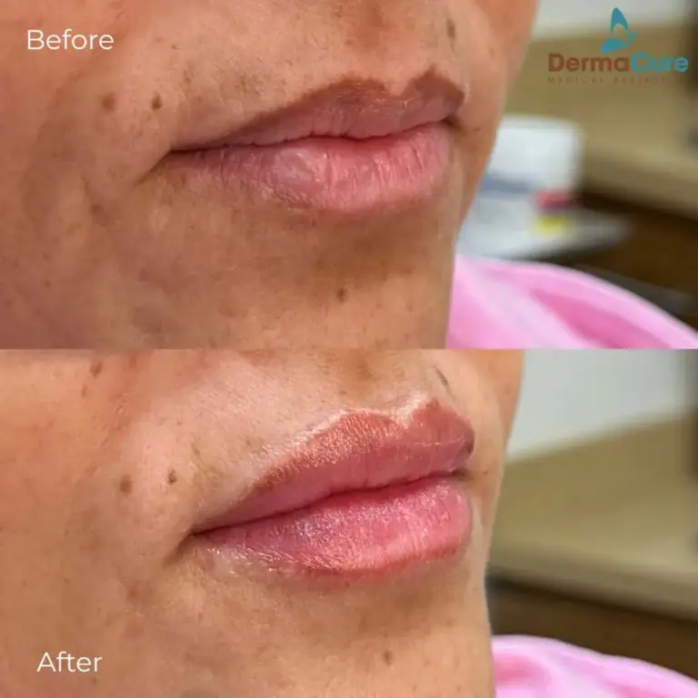 Expert Dermal Fillers in Valencia, CA 6 lip filler