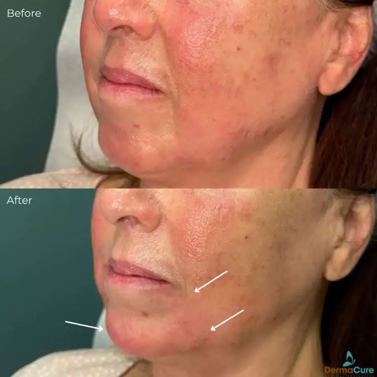 Expert Dermal Fillers in Valencia, CA 7 lip filler