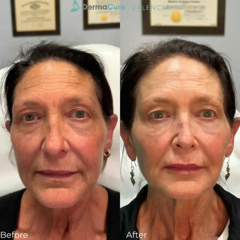 Expert Dermal Fillers in Valencia, CA 8 dermal filler