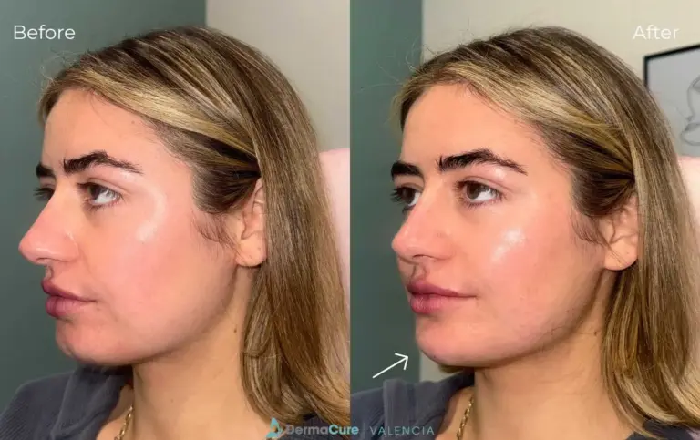 Expert Dermal Fillers in Valencia, CA 9 dermal filler