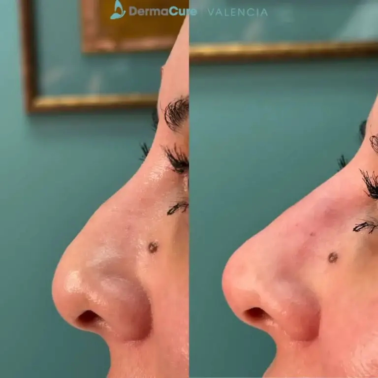 Expert Dermal Fillers in Valencia, CA 11 filler