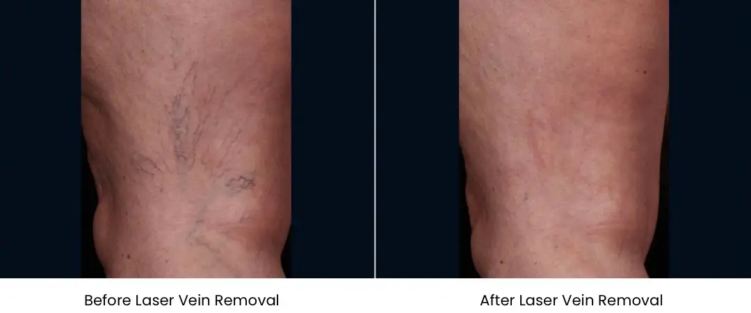 a comparison of varicose veins