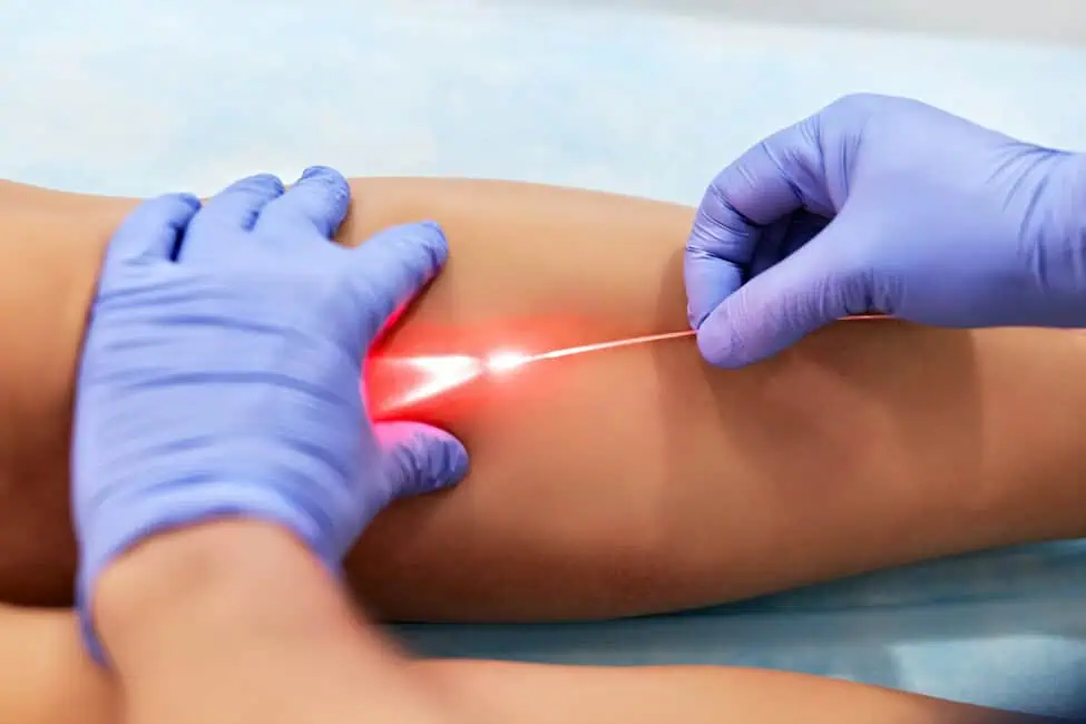 Laser Vein Removal by DermaCure of Valencia in in Valencia, CA (2)