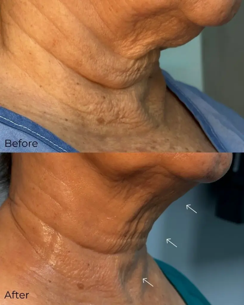 DermaCure of Valencia Titanium Lift in Valencia, CA